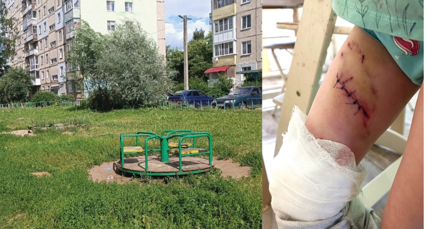  Швы и семь уколов от бешенства: на детской площадке собака растерзала малышку