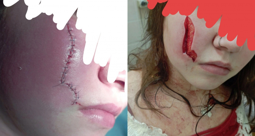 В Ярославле продавщица магазина изуродовала ножом лицо 16-летней девочке