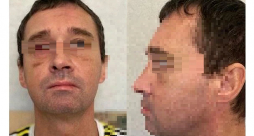 Ярославские медики собрали по крупицам череп мужчины