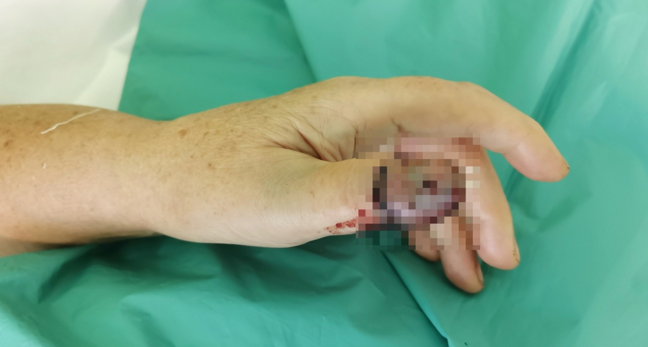 В больницу Ярославля поступили сразу несколько женщин с отрезанными пальцами