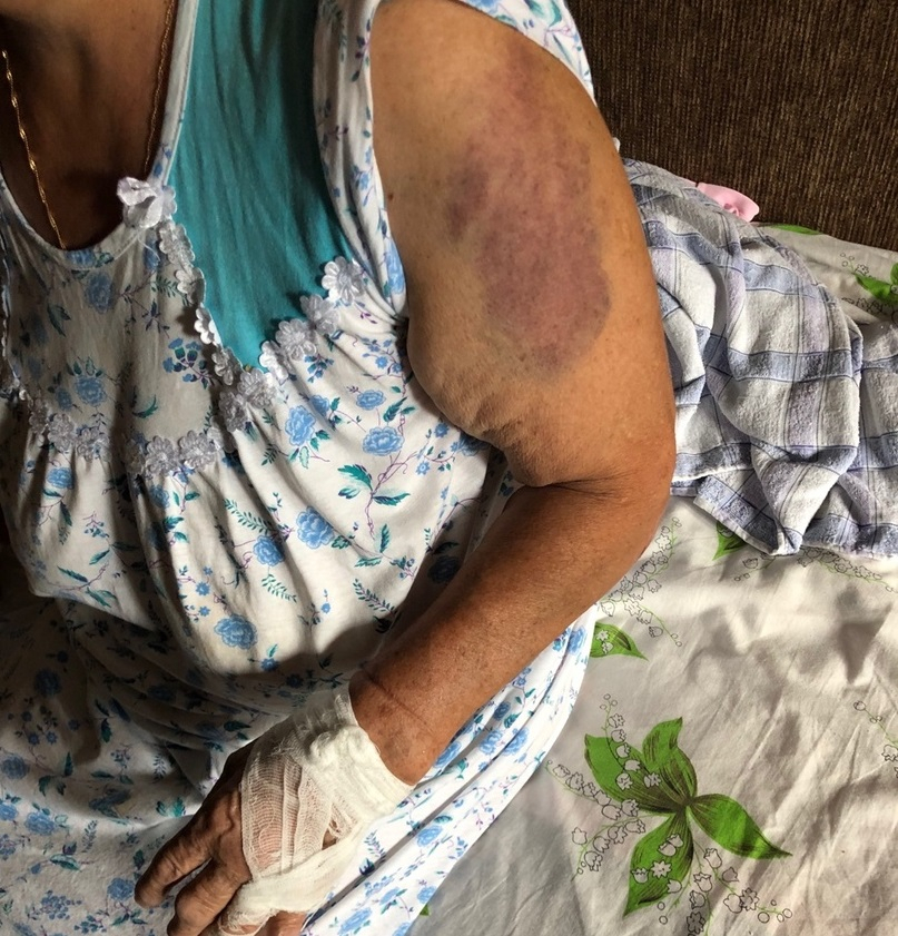 Кровь сочилась от стекла под кожей: школьницы напали  на бабушку в подъезде