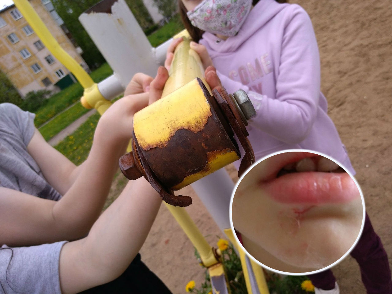 "Подбородок проткнуло насквозь": малышка травмировалась на детской площадке в Ярославле