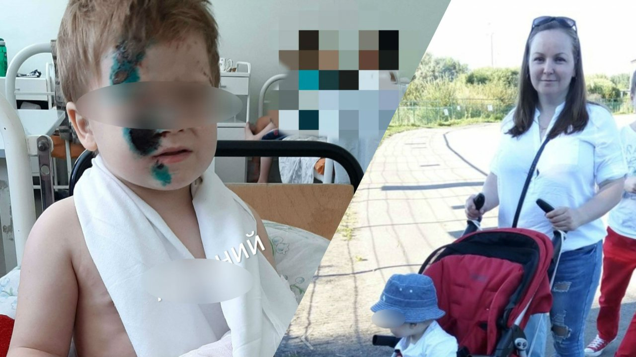 "После ДТП- пересадка кожи и операции": мама сбитого машиной малыша поблагодарила ярославцев за помощь