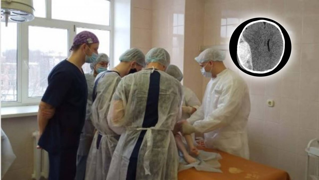 Гематома сдавила полушарие: ярославские хирурги спасли младенца с переломом черепа