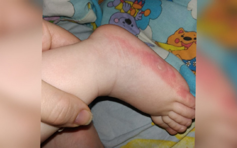 «Обварил ступни и пальцы»: в Рыбинске из-за прорыва труб семья получила серьезные ожоги