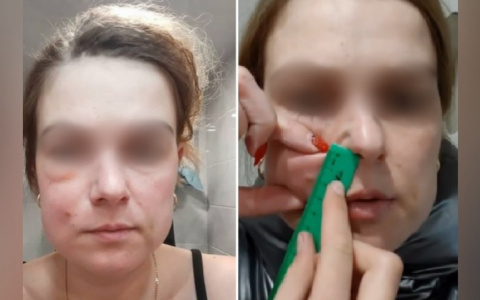 "Щека распухла на пять сантиметров": женщина стала жертвой "уколов красоты»