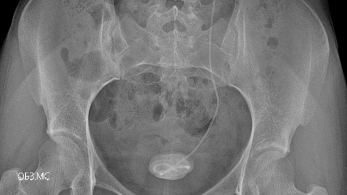 Врачи Ярославля вернули здоровье девушке, полгода жившей с забытым стентом