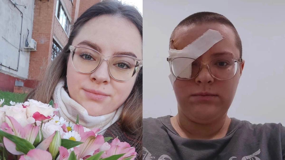 25-летняя ярославна осталась без глаза после атаки БПЛА: "Лена была в коме трое суток"