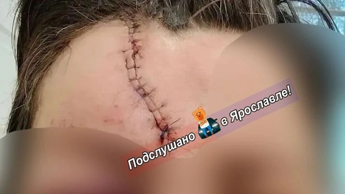 Переход Московского проспекта закончился для ярославны рассеченным лбом