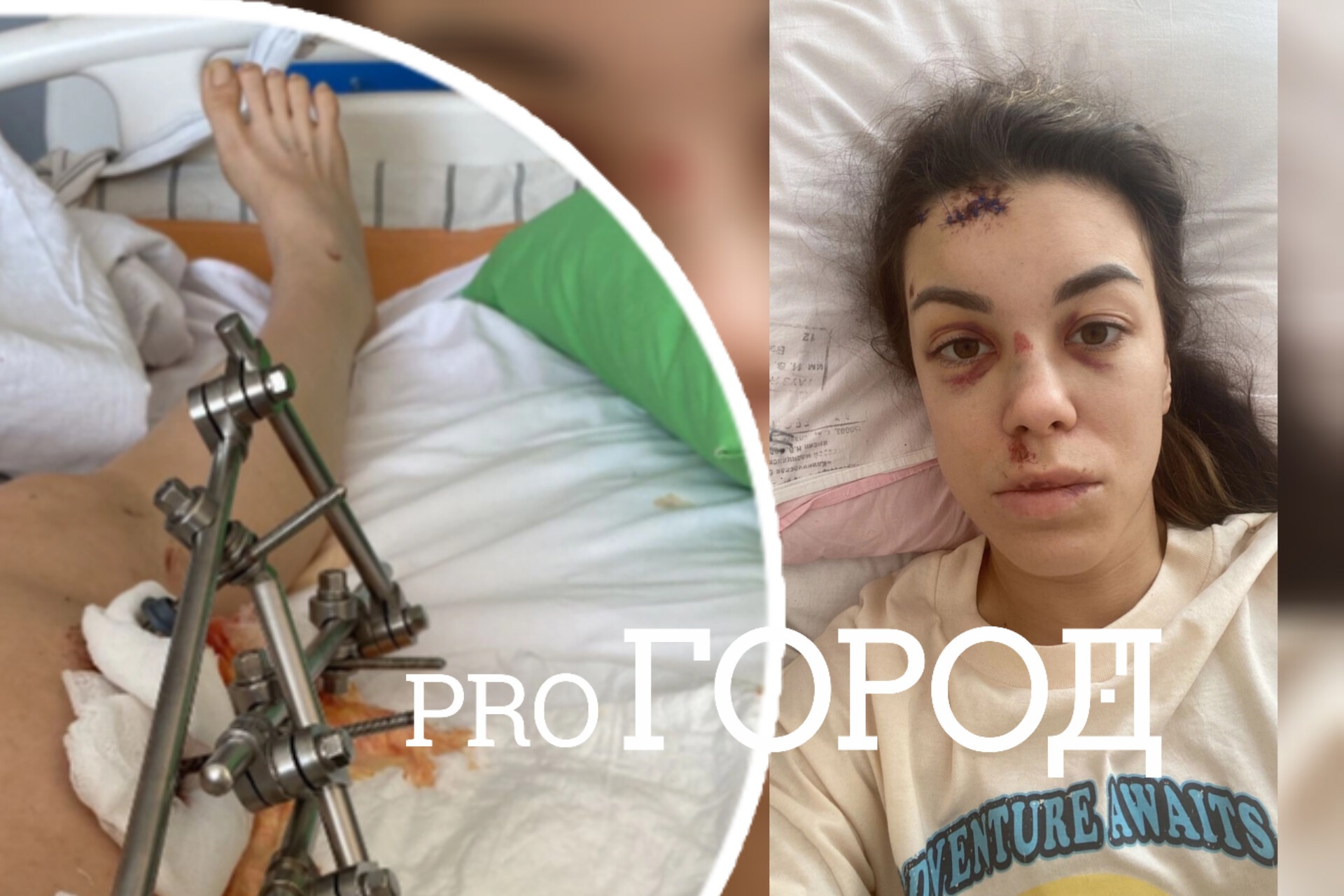"Откинули одеяло, а я вся в железе": в Ярославле водитель отправил в реанимацию врача-реабилитолога